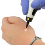 Cryopen device - Cryopen X+